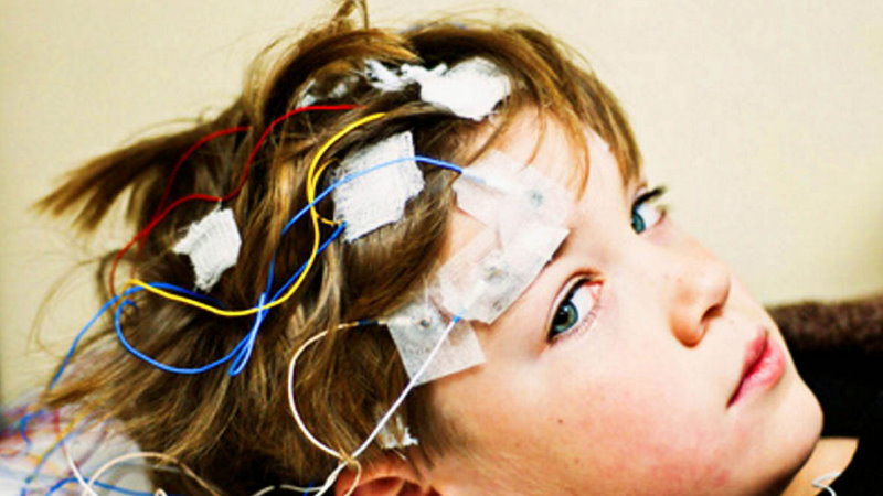 Olejki CBD a epilepsja i lekooporna padaczka